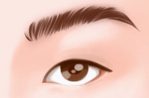 韩式双眼皮手术
