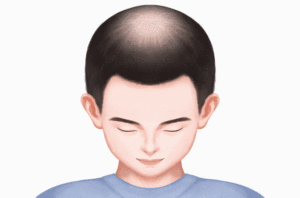 头顶加密种植