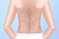 脱背部毛