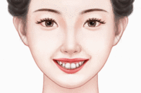 龅牙矫正