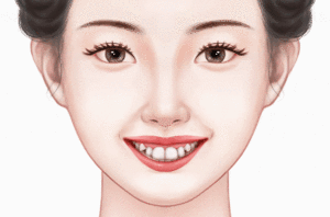 龅牙矫正