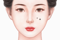 激光点痣
