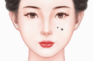 激光点痣