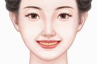 冷光美白