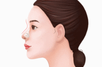 自体肋骨隆鼻手术