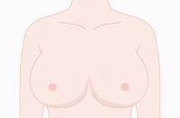 环状乳房缩减术