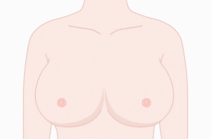 环状乳房缩减术