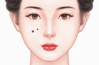 冷冻祛痣法