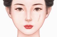 激光去疤痕法