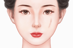 激光去疤痕法