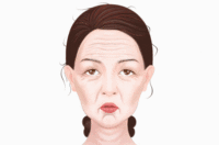 玻尿酸除皱