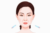 玻尿酸注射去法令纹