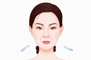 玻尿酸注射去法令纹