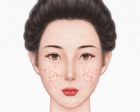黄金微针