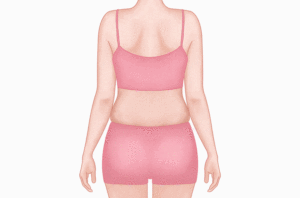 超声溶脂瘦腰部