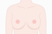 乳晕缩小