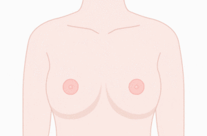 乳晕缩小