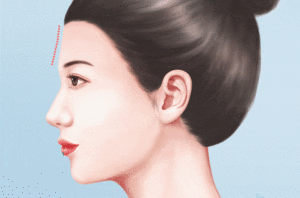 胶原蛋白填充额头