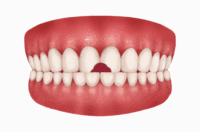 树脂贴面