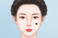 去黑毛痣