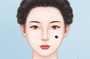 去黑毛痣