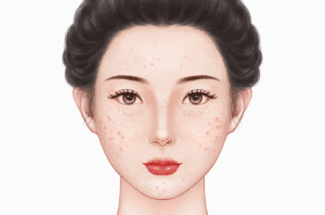 超光子嫩肤