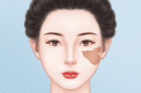 去胎记