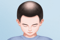 毛囊检测