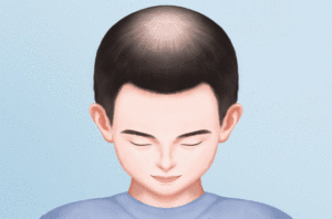 毛囊检测