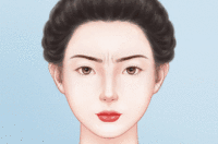 玻尿酸去眉间纹