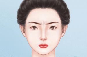 玻尿酸去眉间纹