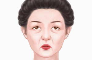 自体脂肪除皱