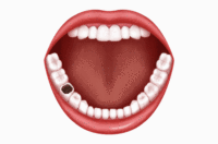 二氧化锆全瓷牙