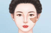 激光去胎记