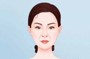 激光去法令纹