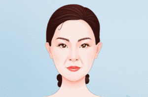 去鼻唇沟