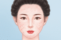 针清去青春痘