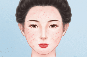 针清去青春痘