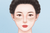 激光去黄褐斑