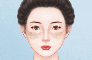激光去黄褐斑