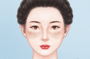 去黄褐斑