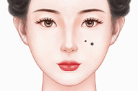 去黑痣