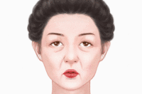 激光除皱