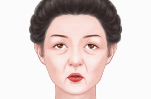 激光除皱