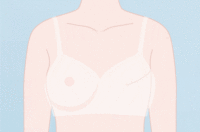 乳房再造