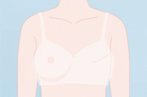乳房再造