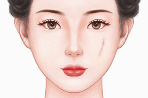 面部疤痕修复