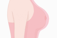乳头内陷矫正
