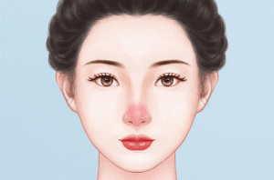 激光治疗酒糟鼻