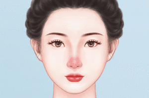冷冻法治疗酒糟鼻